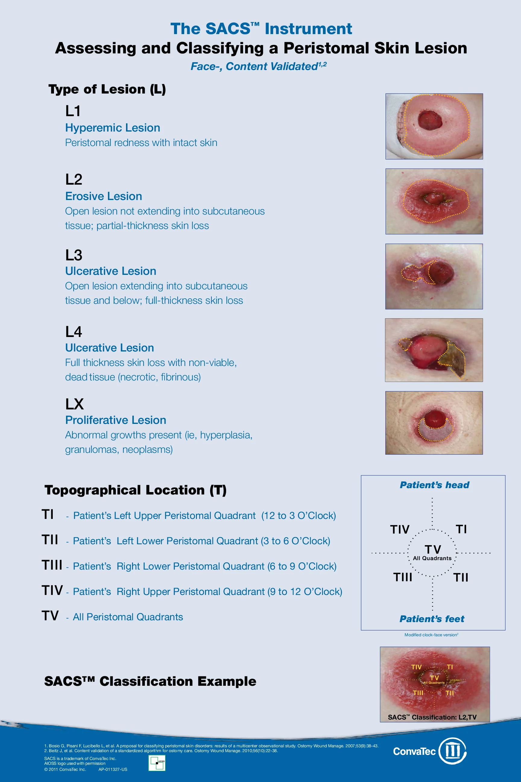 illustration of how to assess and classify peristomal skin lesions