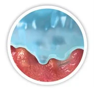 dessin de micro-contours au lit de blessure