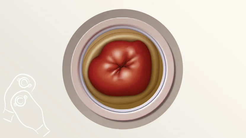 an illustration of an ostomy